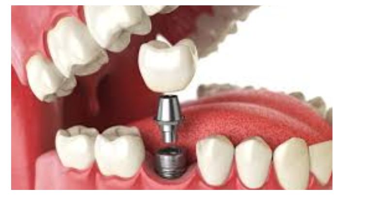 Dental Implants vs. Dentures: Making the Right Choice in 2024